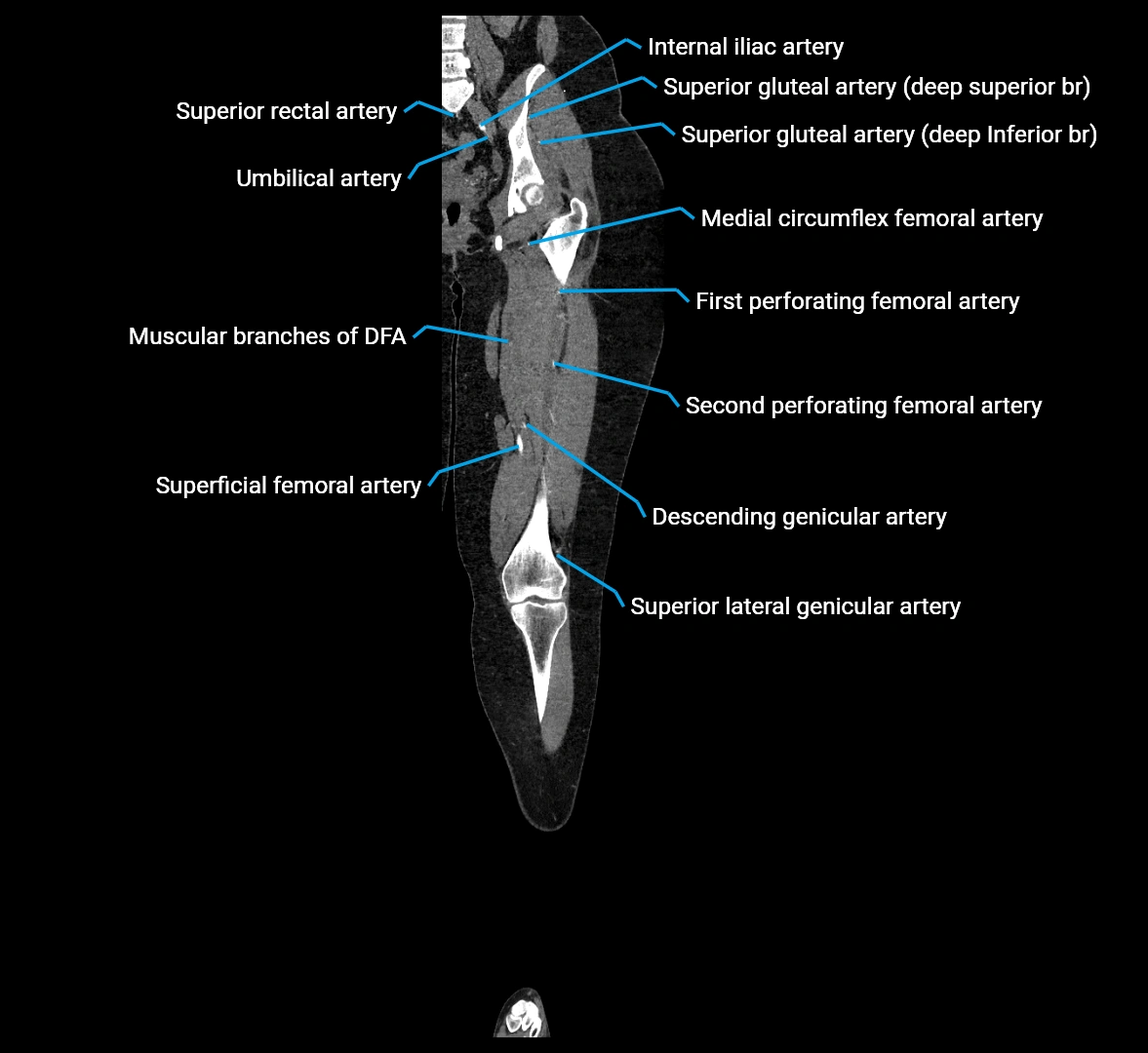 CTA lower limb coronal cross sectional anatomy labelled image _44 (2).webp